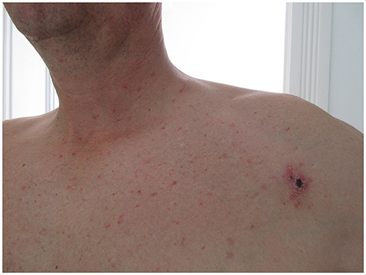 Tularemia: Causes, Symptoms, Diagnosis, and Treatment (Francisella tularensis infection)