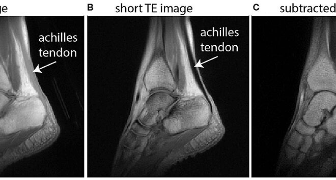 Achilles Tendinitis: Causes, Symptoms, Diagnosis, and Treatment