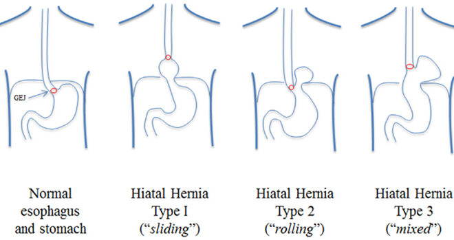 Hiatal Hernia: Overview, Types, Symptoms, Diagnosis & Treatment