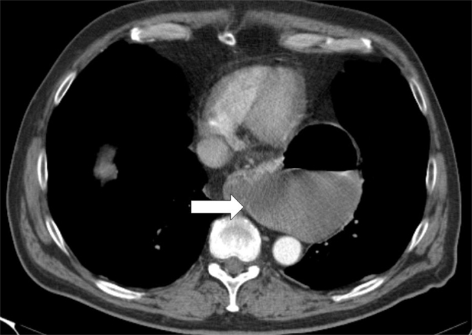 Hiatal Hernia: Overview, Types, Symptoms, Diagnosis & Treatment