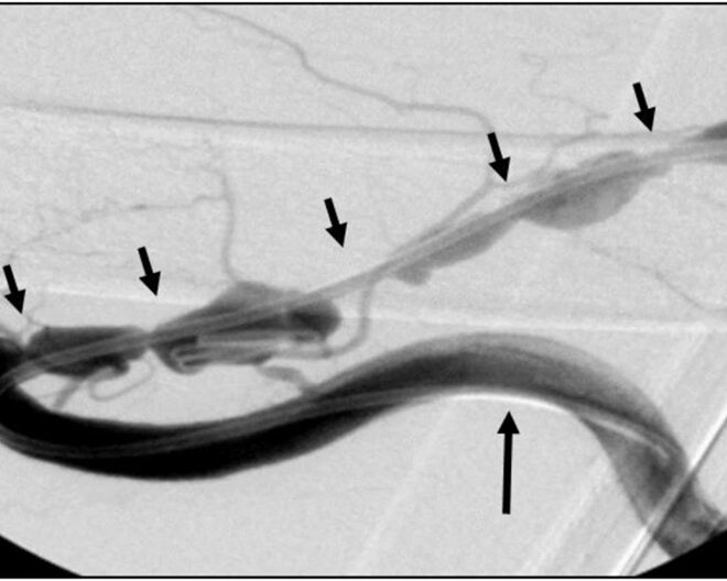 Arteriovenous Fistula: Overview, Causes, Diagnosis, and Treatment