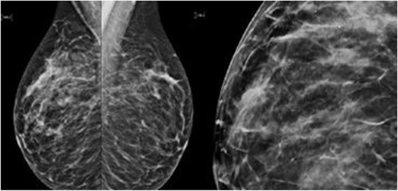 Paget's Disease of the Breast: Symptoms, Diagnosis, and Treatments