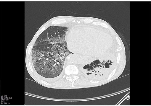 Pleural Empyema: Causes, Symptoms, Diagnosis, and Treatment