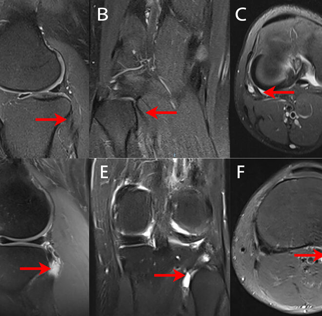 Tendonitis: Causes, Symptoms, and Treatment Options
