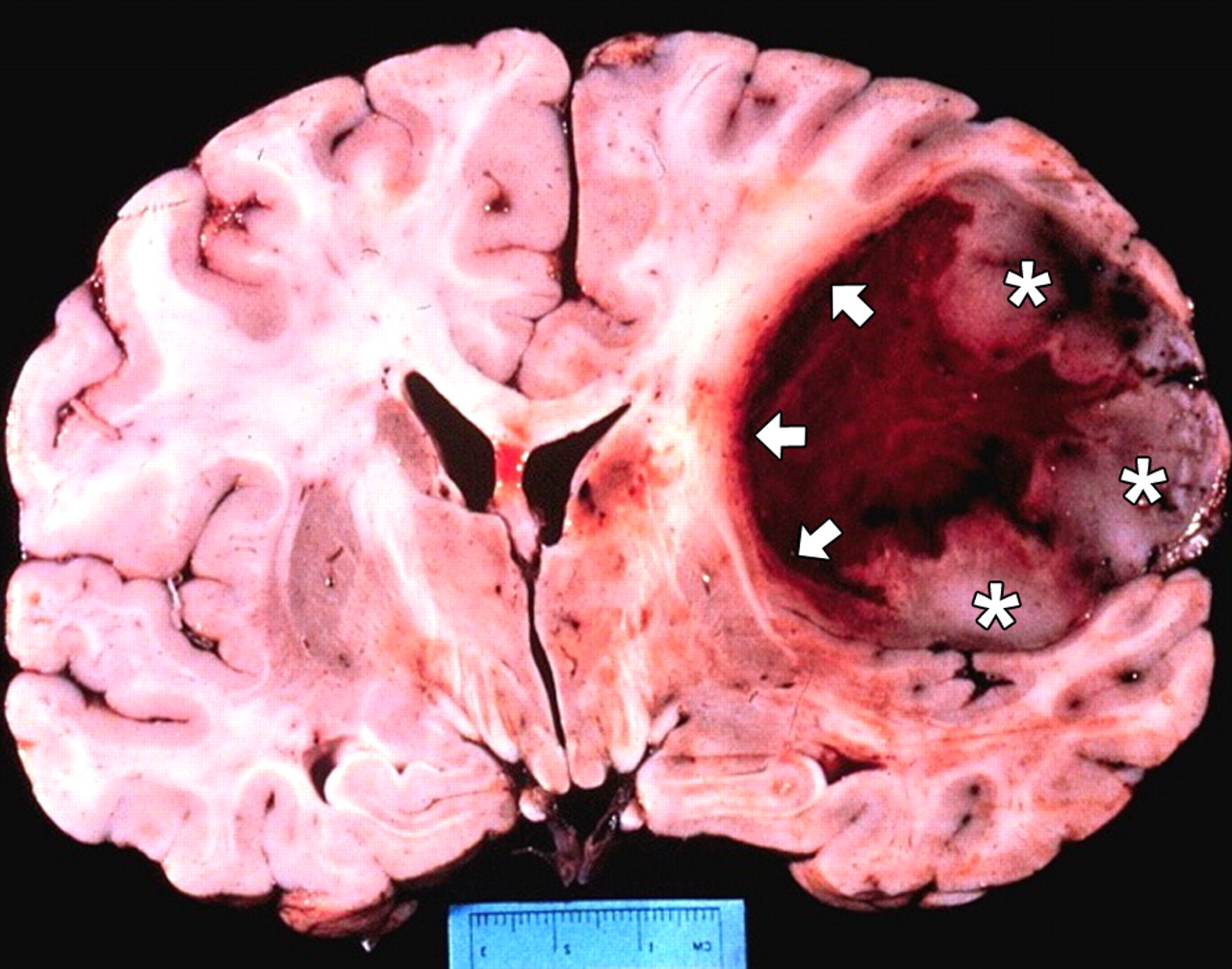 Glioblastoma: Understanding the Most Aggressive Brain Tumor (GBM)
