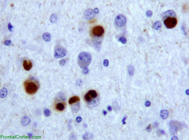 Pick's Disease: A Guide to Frontotemporal Dementia