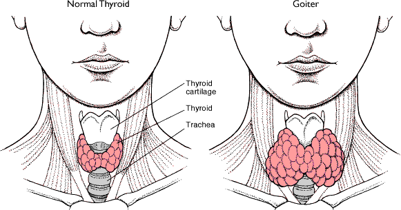 Goiter: Understanding Enlarged Thyroid Glands, Causes, and Treatments