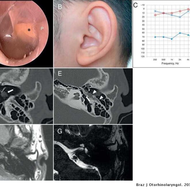 Eardrum Rupture: Causes, Symptoms, Diagnosis, and Treatment