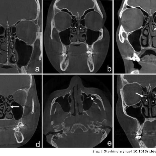 Deviated Nasal Septum: Causes, Symptoms, Diagnosis, and Treatments