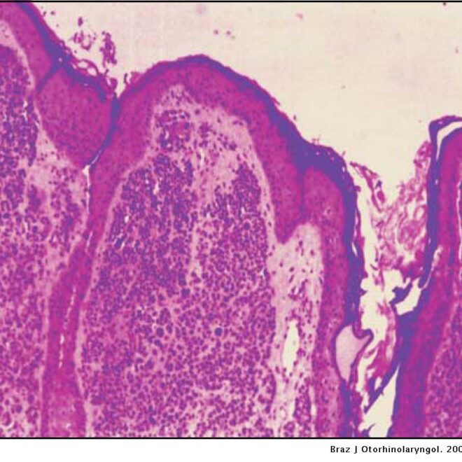 Moles (Melanocytic Nevus): Types, Causes, Diagnosis & Removal