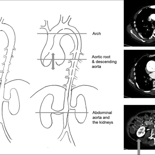 Marfan Syndrome: Causes, Symptoms, and Treatments