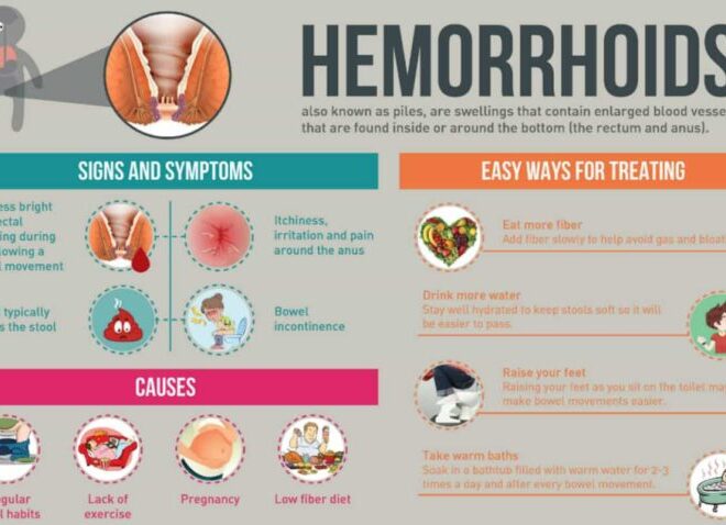 Hemorrhoids: Causes, Symptoms, and Treatment Options