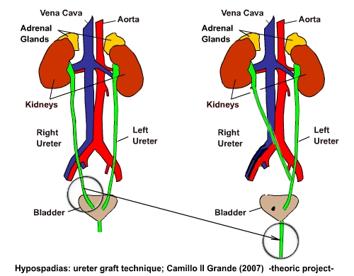 Hypospadias: Understanding the Condition, Its Causes, Diagnosis, and Treatment Options