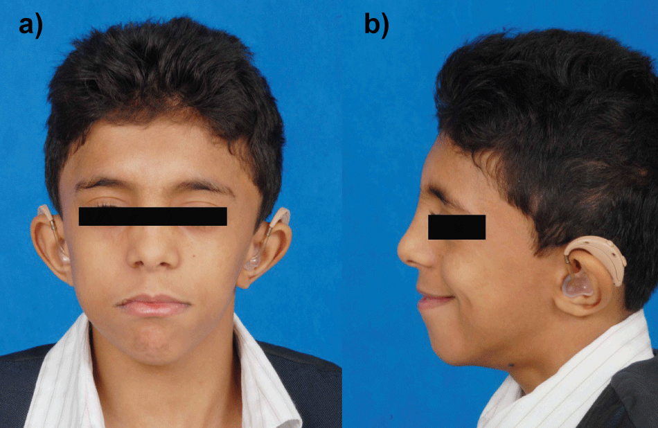 Noonan Syndrome: Causes, Symptoms, Diagnosis, and Treatment