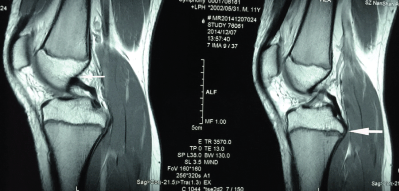 Posterior Cruciate Ligament Tear: Overview, Causes, Diagnosis & Care