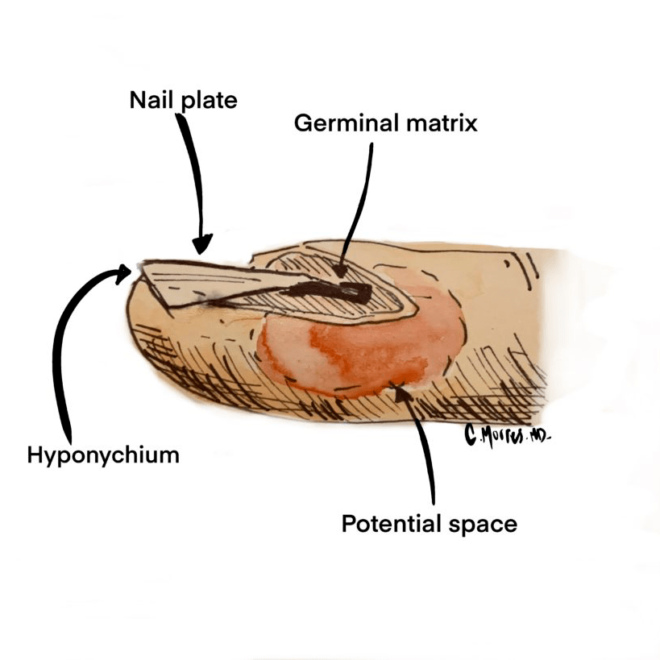 Nail Fold Infection (Paronychia): Causes, Symptoms, and Treatments