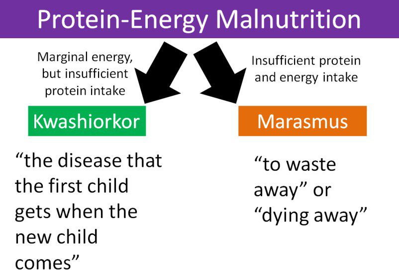 Malnutrition: Types, Causes, Effects, and Prevention