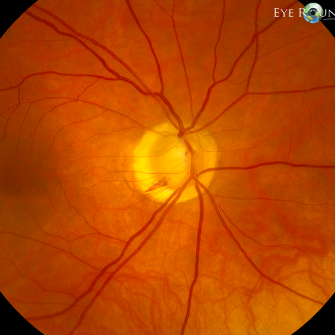 Glaucoma: Causes, Symptoms, and Treatments