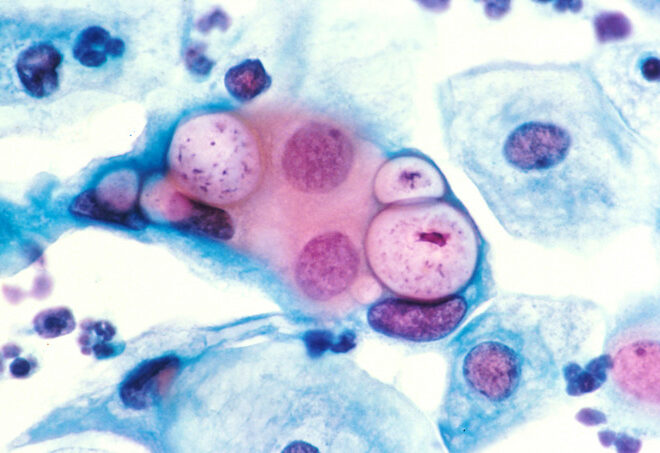 Chlamydia Infection (Sexually Transmitted Bacterial Disease): Overview, Symptoms, Diagnosis, and Treatment