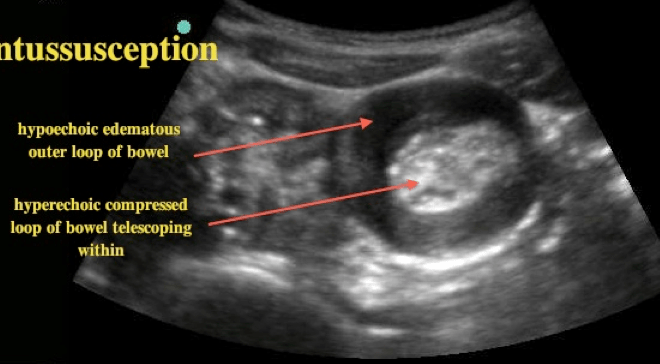 Intussusception: A Guide to Understanding Bowel Blockage (Intestinal Obstruction)