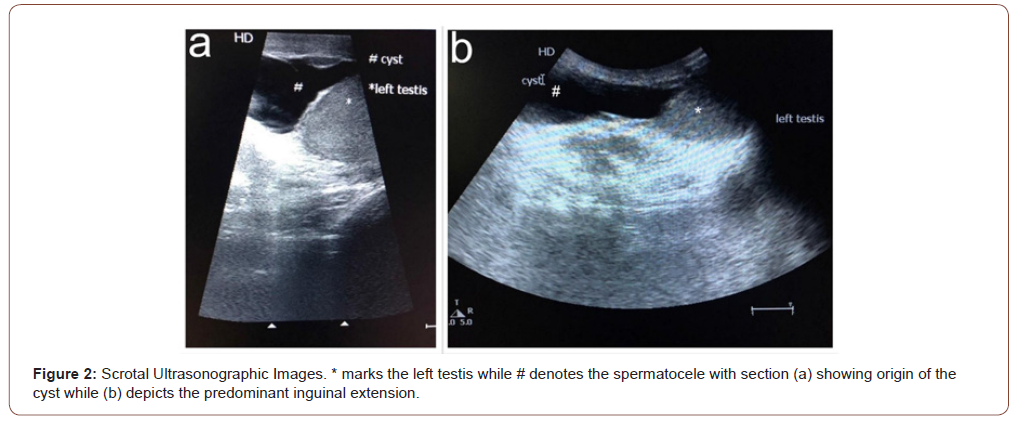 Spermatocele: Overview of Causes, Symptoms, and Treatment Options