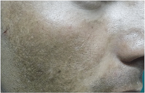 Melasma: Causes, Symptoms, and Treatments