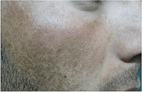 Melasma: Causes, Symptoms, and Treatments