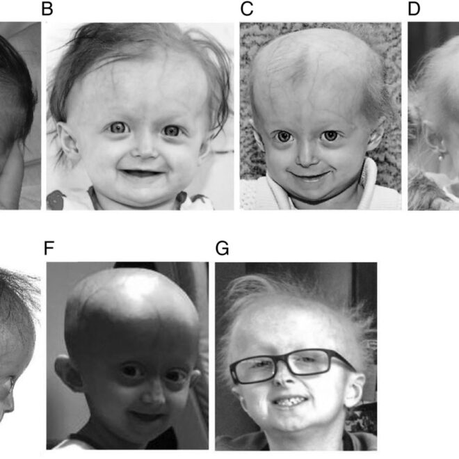 Progeria (Hutchinson-Gilford Progeria Syndrome): Causes, Symptoms, and Care