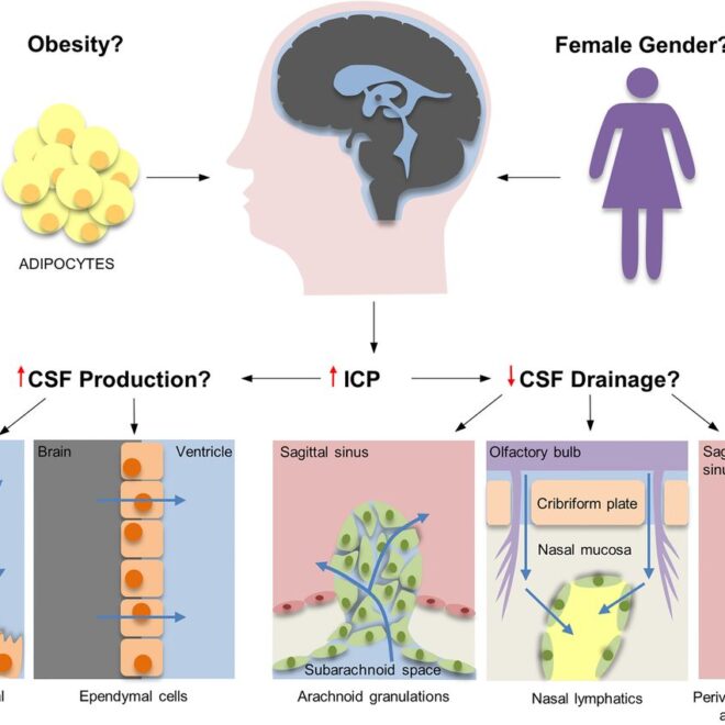 Idiopathic Intracranial Hypertension (IIH): A Complete Guide