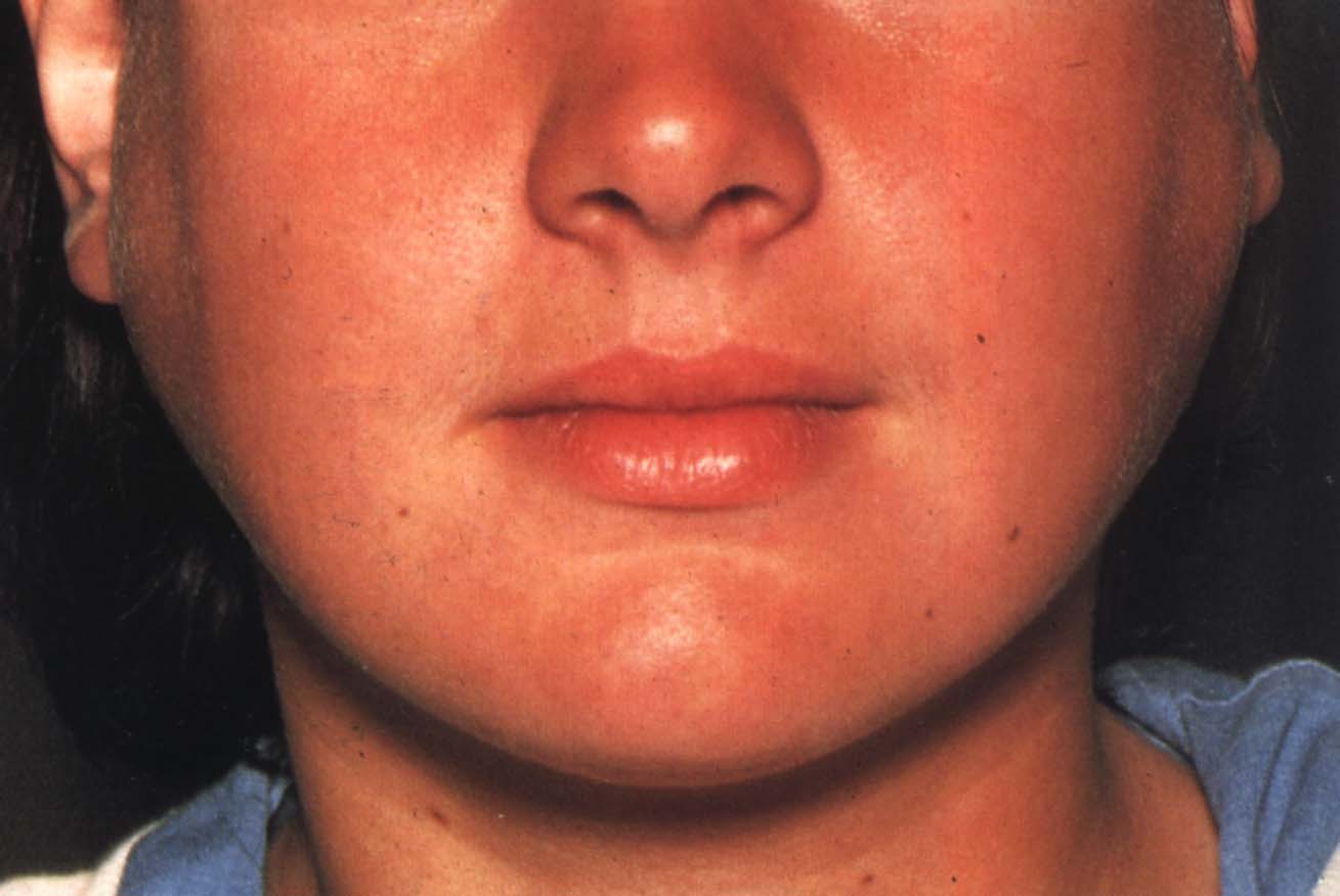 Mumps: Causes, Symptoms, Diagnosis, and Treatment (Parotitis)