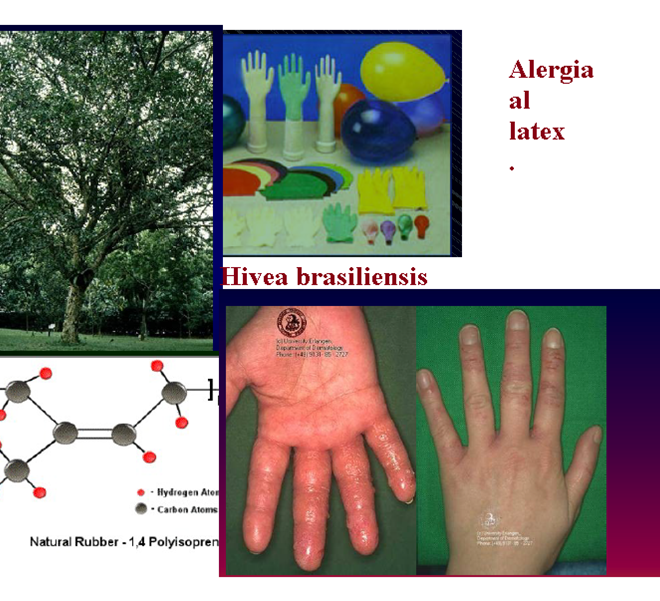 Latex Allergy: An Overview of Causes, Symptoms, and Management