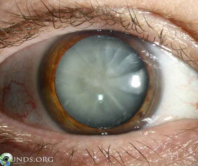 Cataracts: Causes, Symptoms, Diagnosis, and Treatment Options