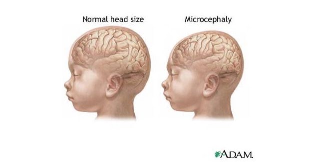 Microcephaly (Small Head Size): Causes, Symptoms, and Care Options