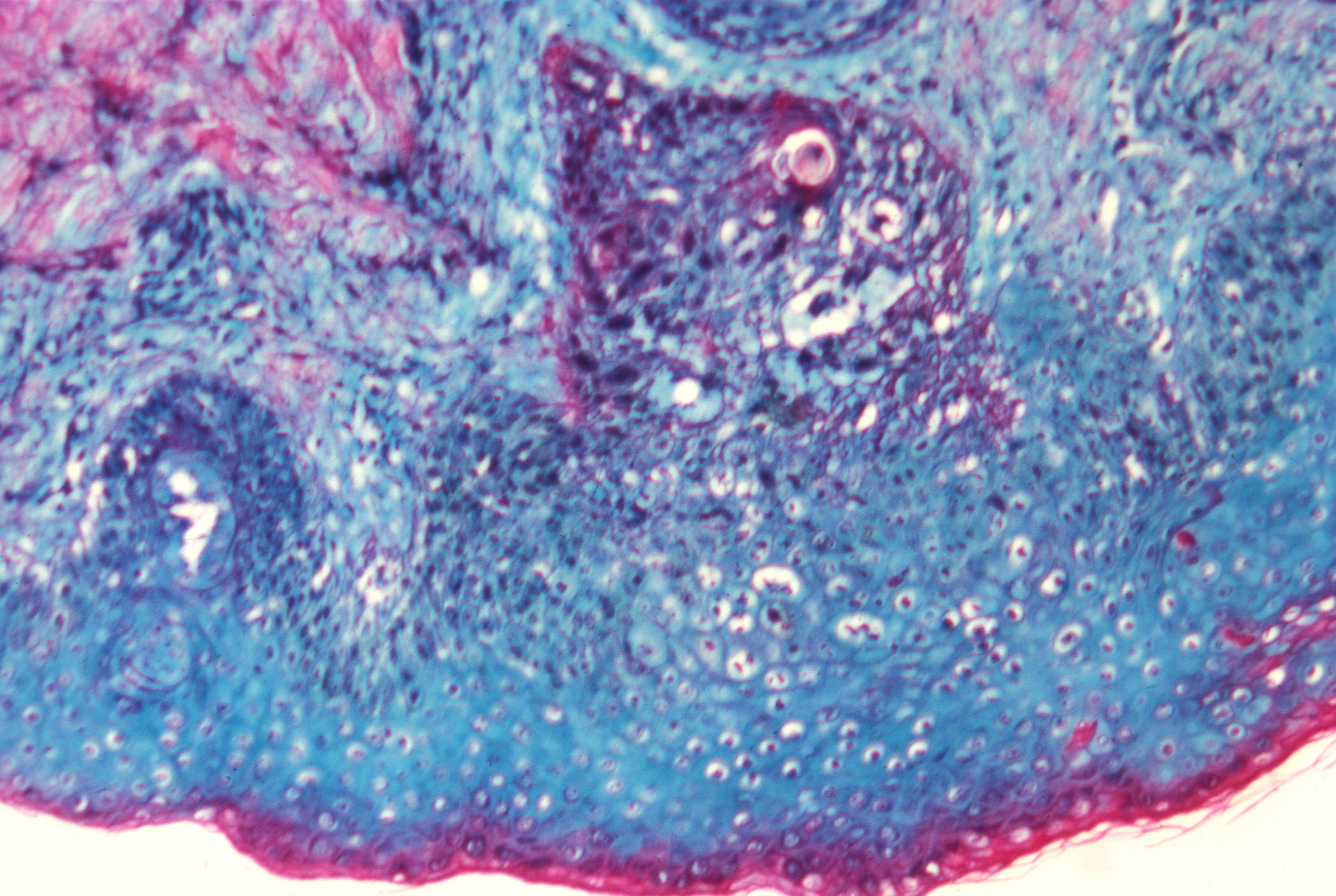 Smallpox: Causes, Symptoms, Transmission, and Eradication