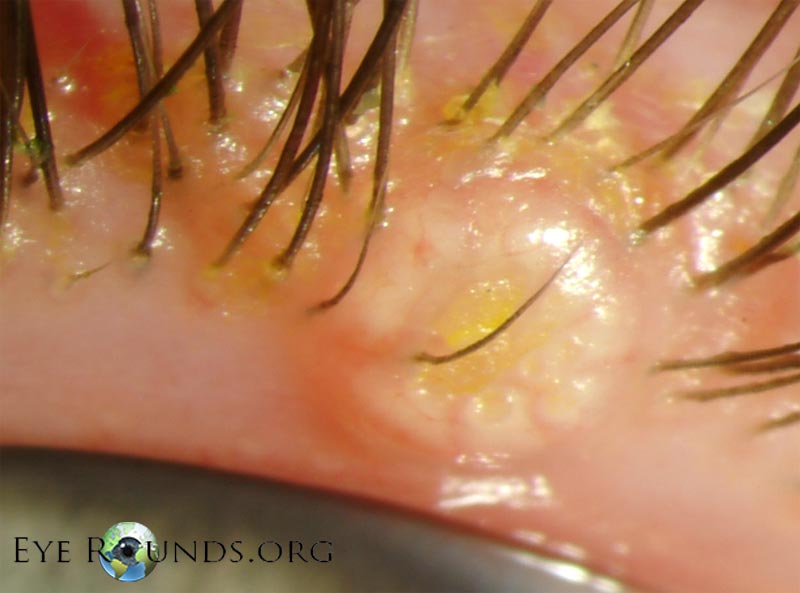 Molluscum Contagiosum: Overview, Causes, Symptoms & Treatments