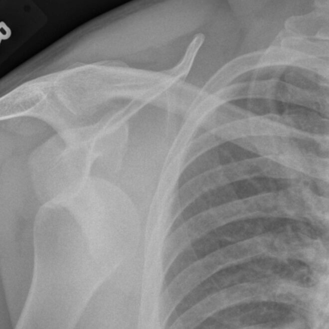 Shoulder Dislocation: Causes, Symptoms, Diagnosis, and Treatment