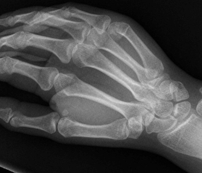 Broken Wrist (Colles Fracture): Causes, Symptoms, Diagnosis & Recovery