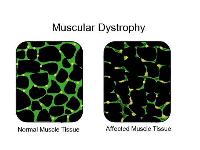 Muscular Dystrophy: Types, Causes, Symptoms, and Treatments
