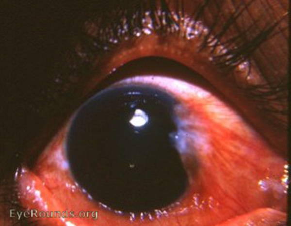 Pterygium: Causes, Symptoms, and Treatment Options