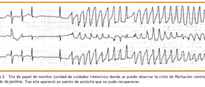 Tietze Syndrome: What It Is, Causes, Symptoms & Treatment