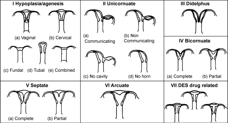 Prolapsed Uterus (Uterine Prolapse): Overview, Symptoms, Causes & Treatments