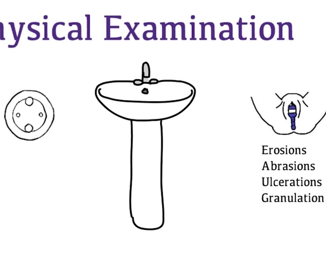 Pelvic Organ Prolapse (Including Enterocele): Overview, Symptoms, Diagnosis & Treatment