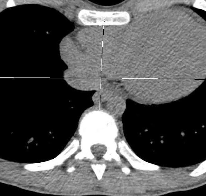 Pectus Excavatum: Understanding the Condition, Causes, Diagnosis, and Treatments