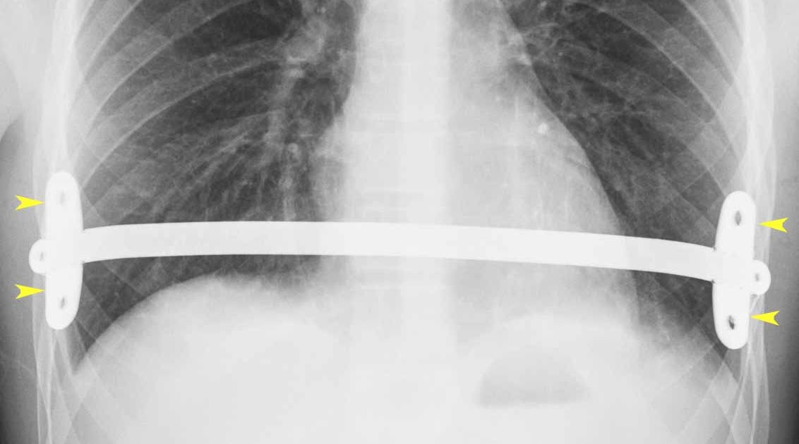 Pectus Excavatum: Understanding the Condition, Causes, Diagnosis, and Treatments