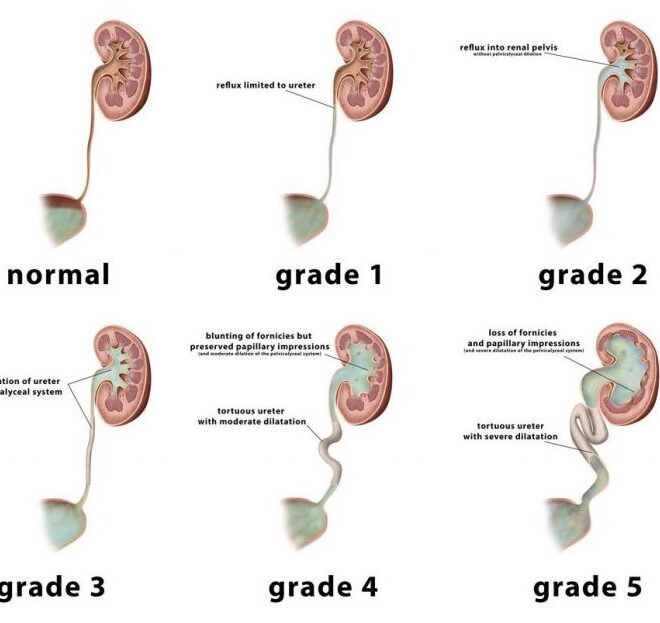 Vesicoureteral Reflux: Causes, Symptoms, Diagnosis, and Treatment