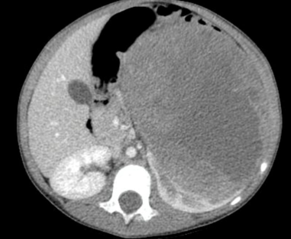 Wilms Tumor (Kidney Cancer in Children): Overview, Symptoms, Diagnosis & Treatment