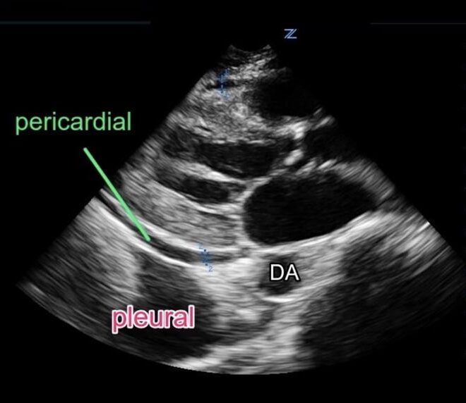 Pericardial Effusion: Causes, Symptoms, Diagnosis & Treatment