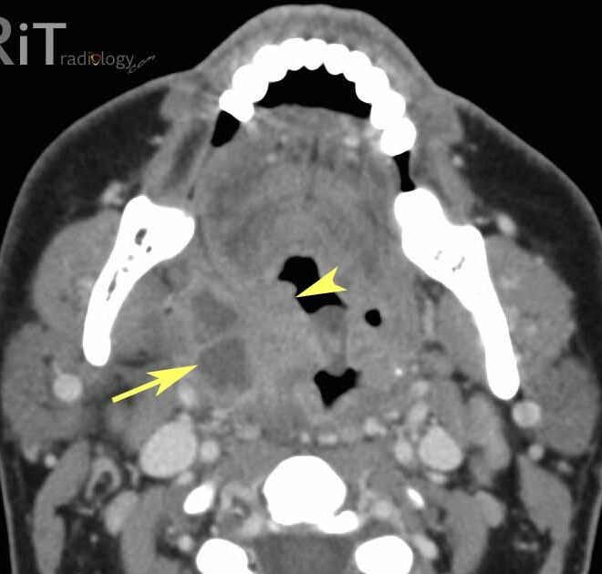 Peritonsillar Abscess: Causes, Symptoms, Diagnosis, and Treatment
