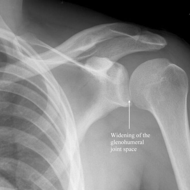 Joint Displacement: Types, Causes, and Treatments