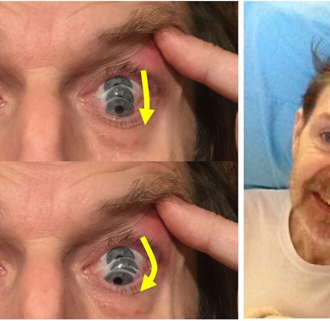 Progressive Supranuclear Palsy: Overview, Symptoms, Diagnosis & Care